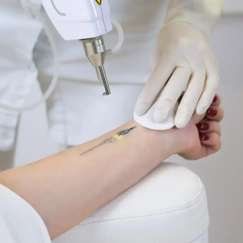 Tattoo regret and removal with professional laser treatment on wrist by certified specialist