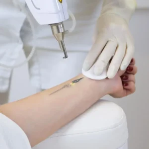 Tattoo regret and removal with professional laser treatment on wrist by certified specialist