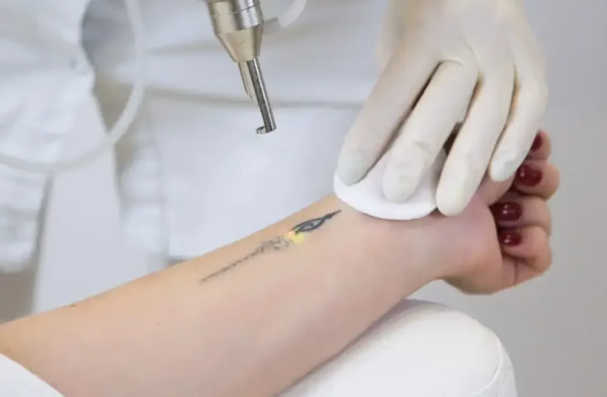 Tattoo Regret and Removal: Safe Methods & Emotional Healing